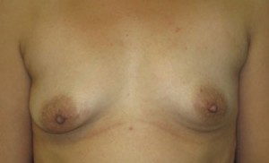 Breast Augmentation and Lift