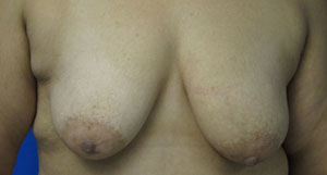 Breast Augmentation and Lift