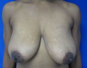 Breast Augmentation and Lift