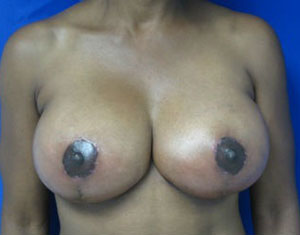 Breast Augmentation and Lift