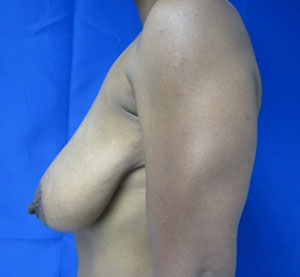 Breast Augmentation and Lift
