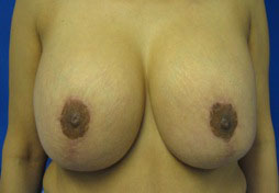 Breast Augmentation and Lift
