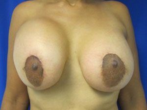 Breast Augmentation and Lift