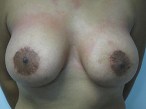 Breast Augmentation and Lift