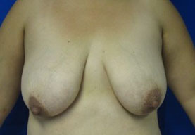 Breast Augmentation and Lift
