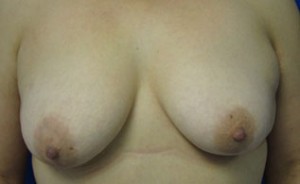 Breast Lift