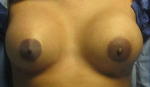 Breast Lift