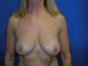 Breast Lift