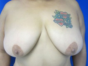 Breast Lift