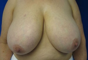 Breast Lift
