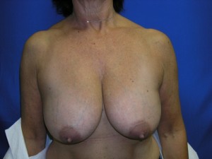 Breast Reduction