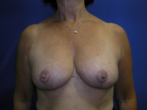 Breast Reduction