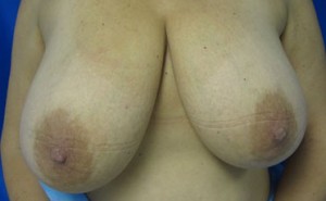 Breast Reduction