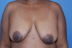 Breast Reduction