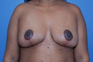 Breast Reduction
