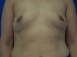 Breast Augmentation Revision