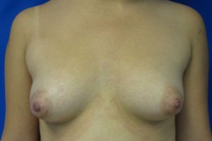 Breast Augmentation Revision