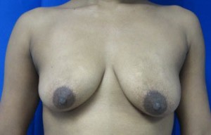 Breast Augmentation Revision