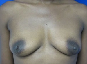 Breast Augmentation Revision