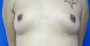 Breast Augmentation Revision