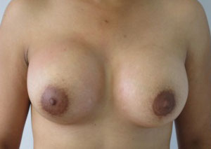 Breast Augmentation Revision