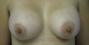Breast Augmentation Revision