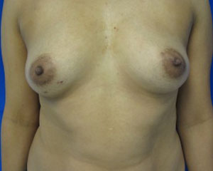Breast Augmentation Revision