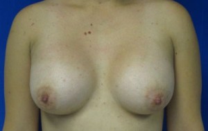 Breast Augmentation Revision