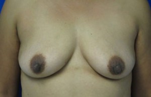 Breast Augmentation Revision