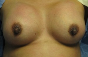 Breast Augmentation Revision