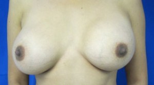 Breast Augmentation Revision