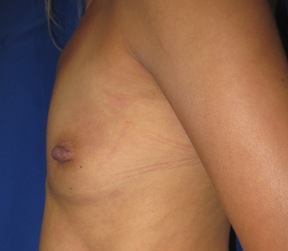 Breast Augmentation Revision