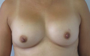Breast Augmentation Revision