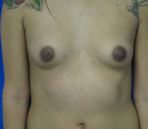 Breast Reconstruction and Breast Deformity Correction