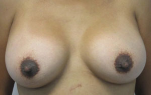 Breast Reconstruction and Breast Deformity Correction