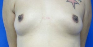 Breast Reconstruction and Breast Deformity Correction