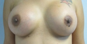 Breast Reconstruction and Breast Deformity Correction