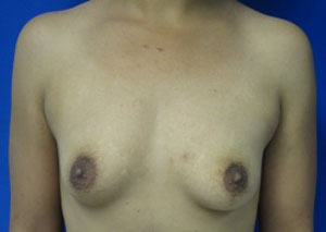 Breast Reconstruction and Breast Deformity Correction