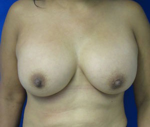 Breast Reconstruction and Breast Deformity Correction
