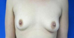 Breast Reconstruction and Breast Deformity Correction