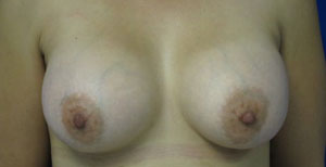 Breast Reconstruction and Breast Deformity Correction