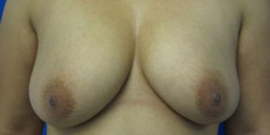 Breast Reconstruction and Breast Deformity Correction