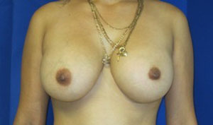 Breast Reconstruction and Breast Deformity Correction