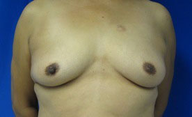 Breast Reconstruction and Breast Deformity Correction
