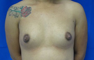 Breast Reconstruction and Breast Deformity Correction