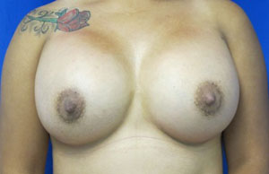 Breast Reconstruction and Breast Deformity Correction
