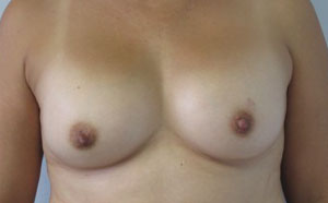 Breast Reconstruction and Breast Deformity Correction