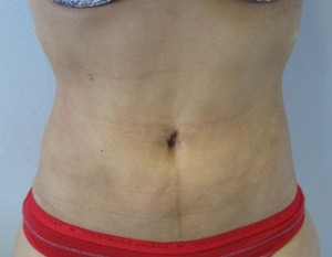 Liposuction