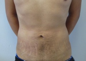 Liposuction