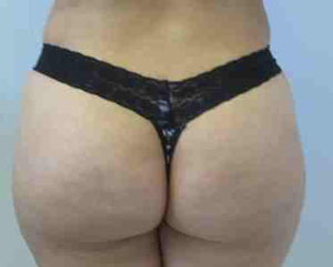 Brazilian Butt Lift